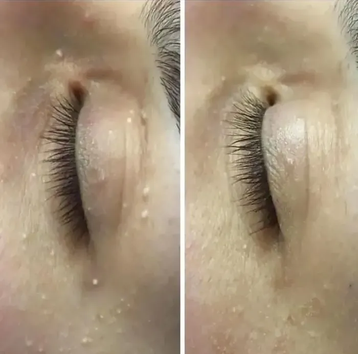 Before and after milia removal around the eye area at Glamsoul Beauty, Kingston upon Thames