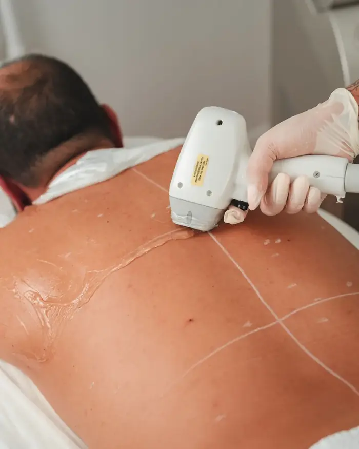 Soprano Titanium laser hair removal at Glamsoul Beauty, Kingston upon Thames