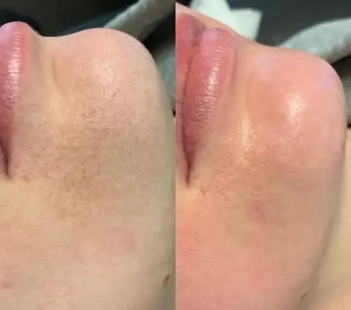 Before and after a HydraFacial at Glamsoul Beauty, Kingston upon Thames