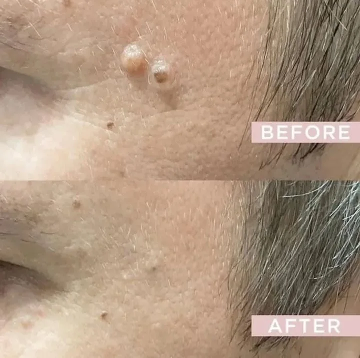 Before and after skin tag removal on the face at Glamsoul Beauty, Kingston upon Thames