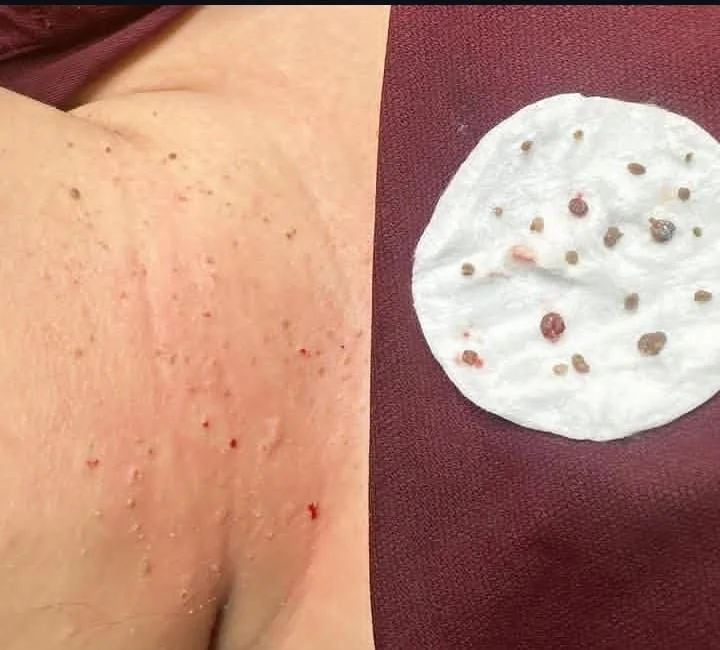 Multiple skin tags removed from the underarm area in a single appointment at Glamsoul Beauty